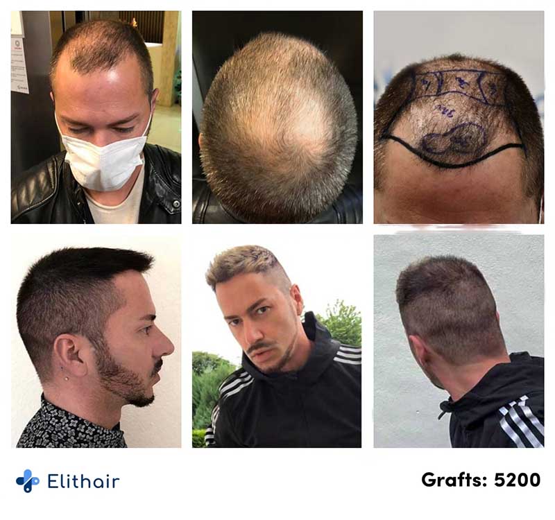 image showing the before after picture of Andre's DHI hair transplant at Elithair with 5200 grafts