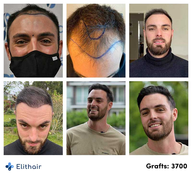 Thumbnail picture before and after the DHI hair transplant with 3700 grafts of Sebastian