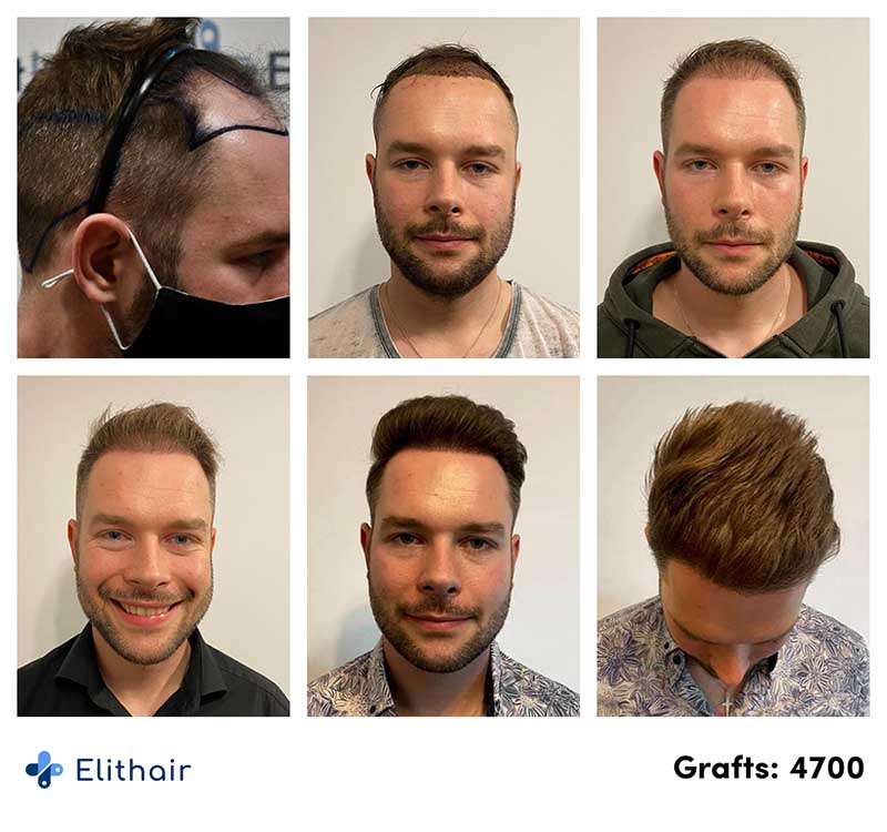Elithair patient Michael shows his before and after pictures with the DHI hair transplant