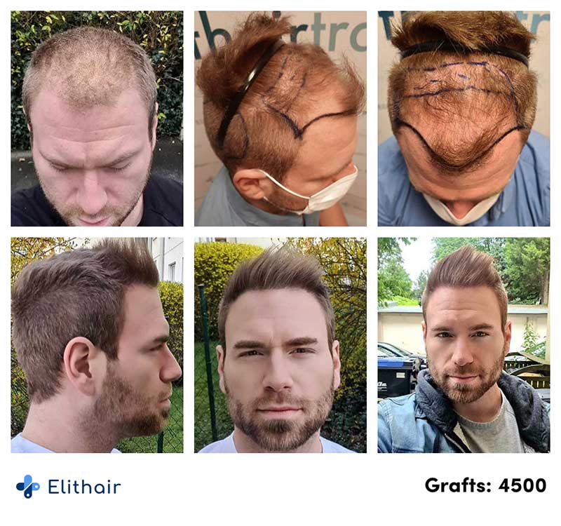 Thumbnail picture before and after of Kewin's hair transplant with 4500 grafts at Elithair