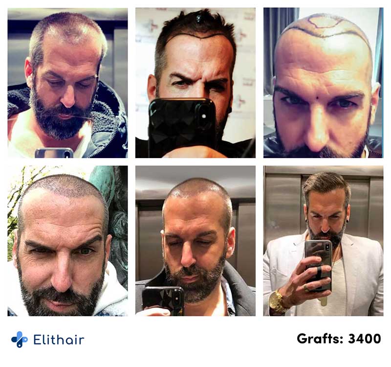 Thumbnail picture before and after of Jürgen's fue hair transplant with 3400 grafts at Elithair