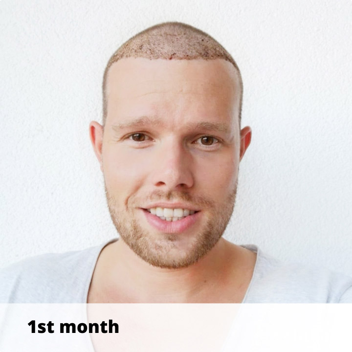 Elithair patient shows his hair transplant recovery after 1 month