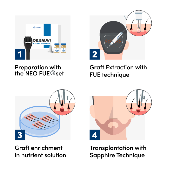 Infographic showing the 4 steps of the beard transplant