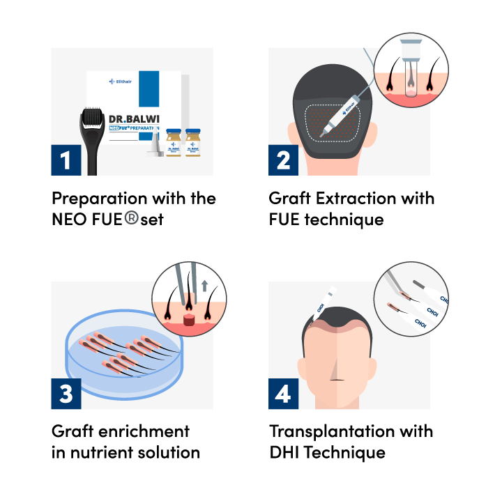 Infographic showing the 4 steps of a DHI hair transplant procedure