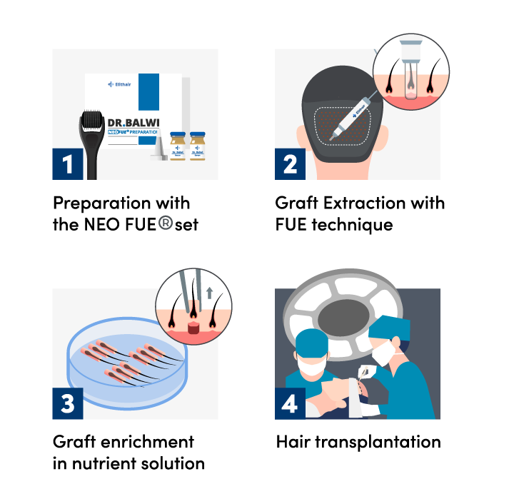 Infographic showing the 4 steps of a FUE hair transplant