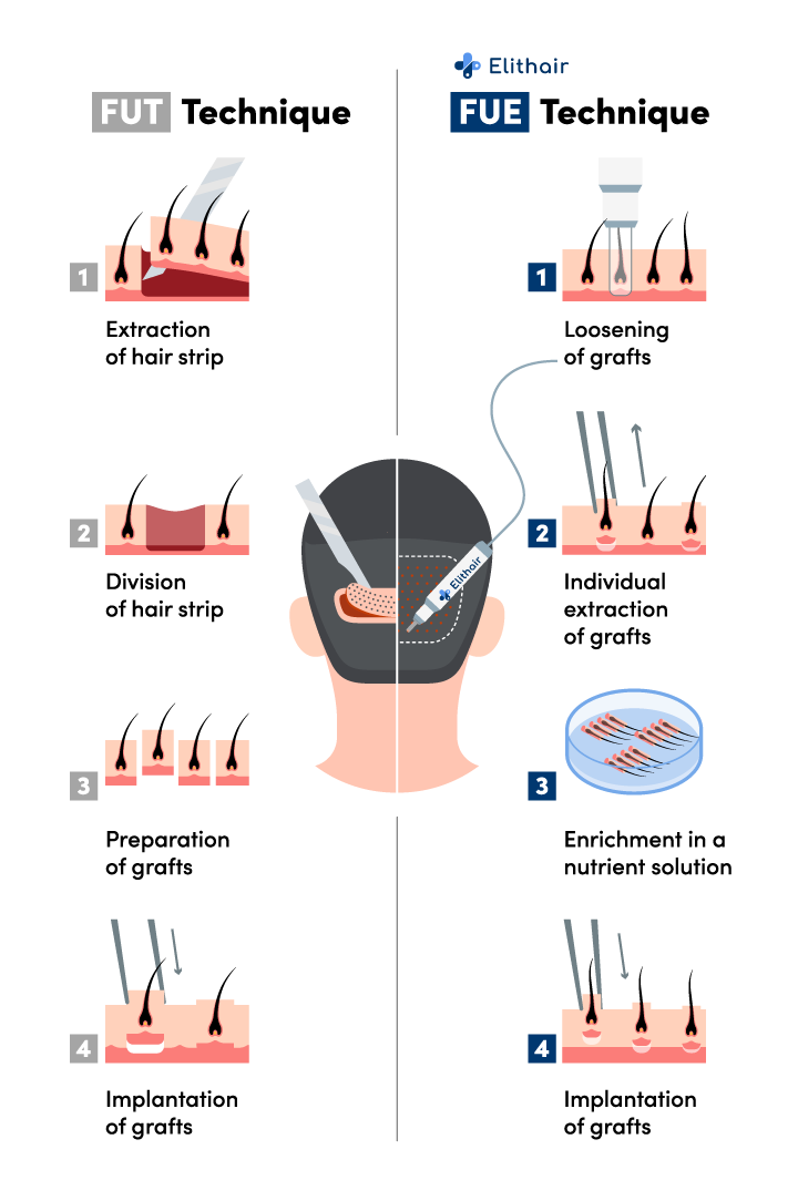Infographic showing the differences between the FUE and FUT hair transplant techniques