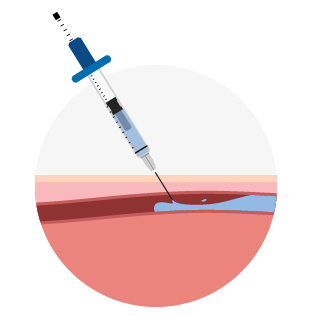 infographic showing a a sedation injection into the skin