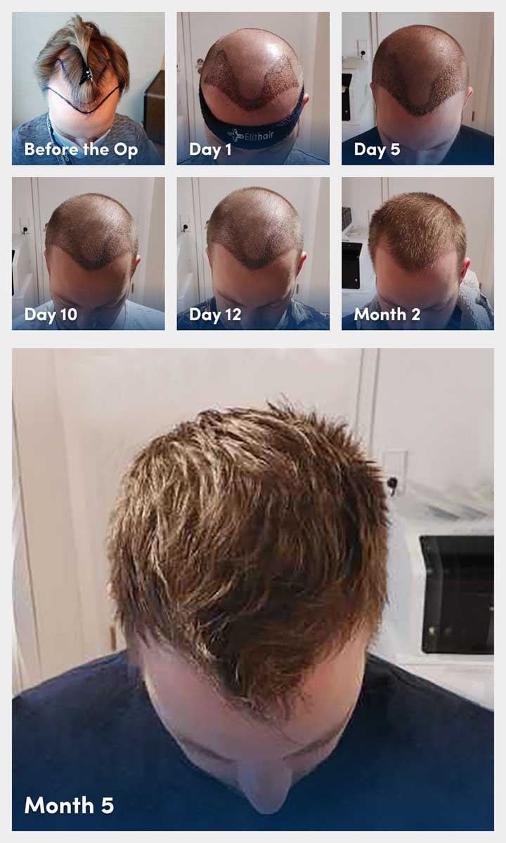 Infographic with photos showing the stages of the healing and recovery process after a hair transplant from day one to five months