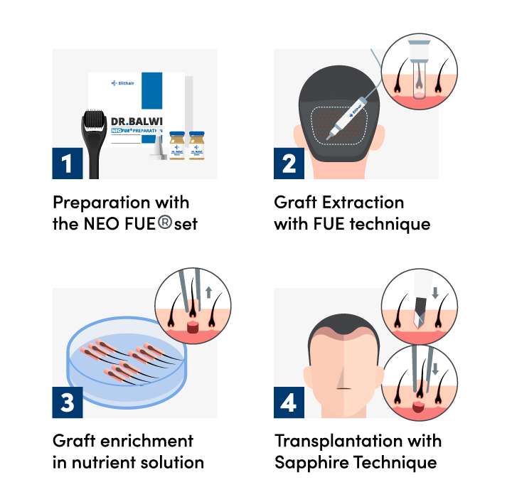 Infographic showing the steps of the sapphire hair transplant procedure at Elithair
