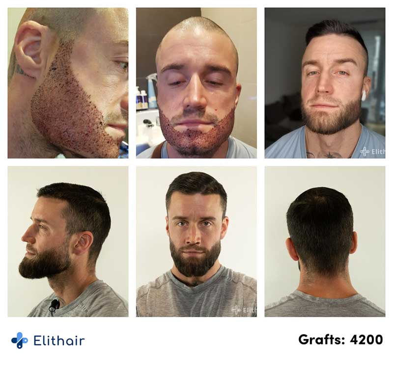 Thumbnail picture before and after the beard transplant with 4200 grafts of Jhaki, an Elithair patient