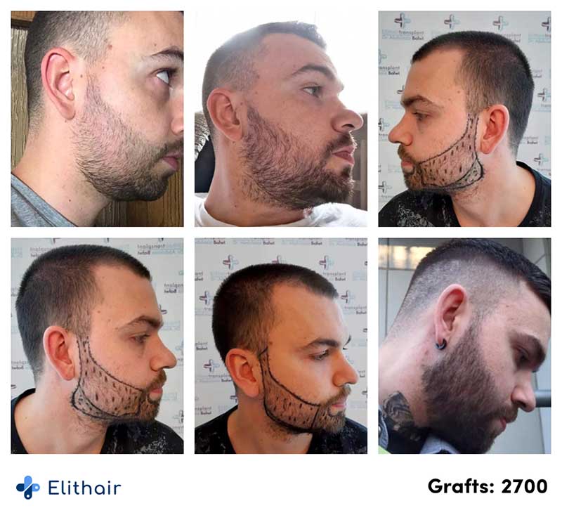 Thumbnail picture before and after the beard transplant with 2700 grafts of Nico, an Elithair patient
