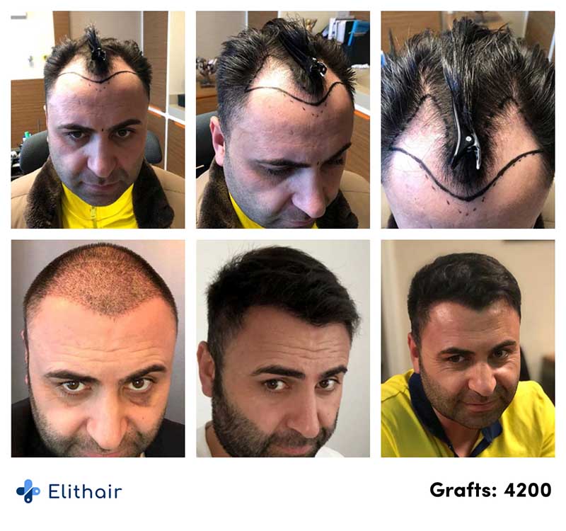 before after pictures of Murat, an Elithair patient, who undertook a hair transplant with 4200 graft