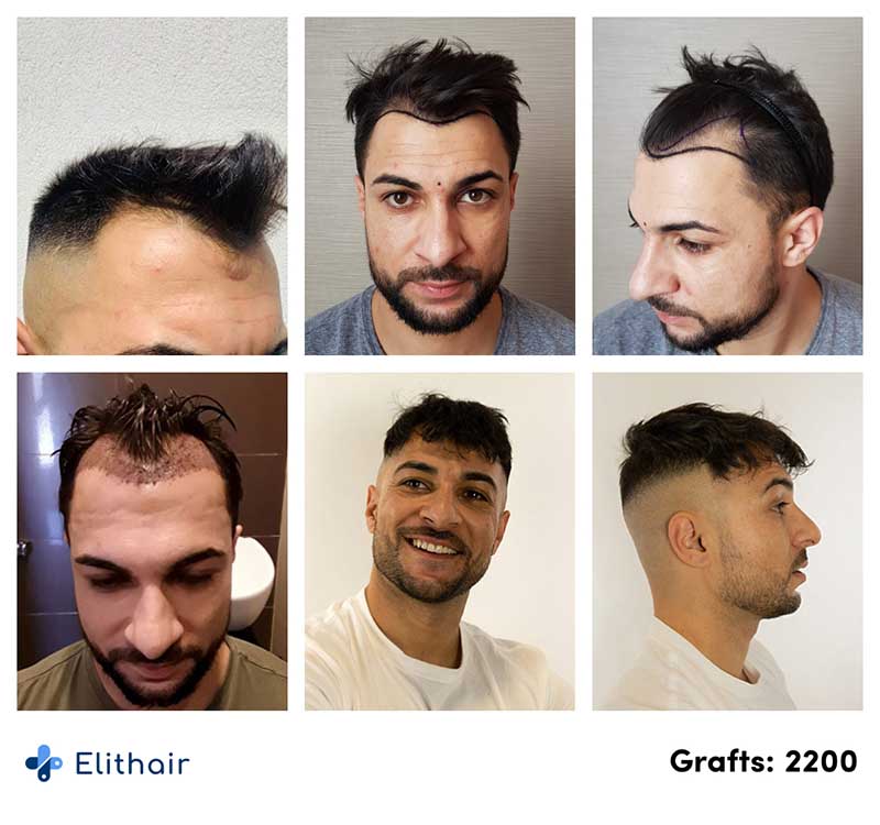 before after pictures of Osmani, an Elithair patient, who undertook a hair transplant with 2200 graft