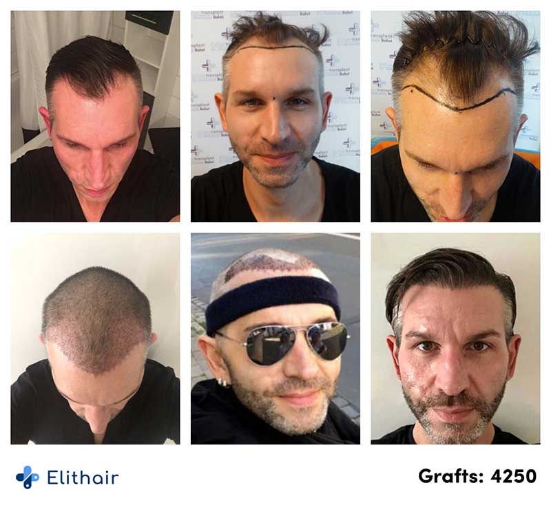 before after pictures of Thomas, an Elithair patient, who undertook a hair transplant with 4250 graft
