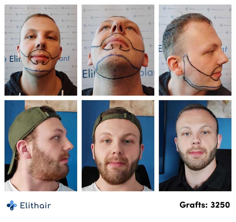 Thumbnail picture before and after the beard transplant with 3250 grafts of Sascha, an Elithair patient
