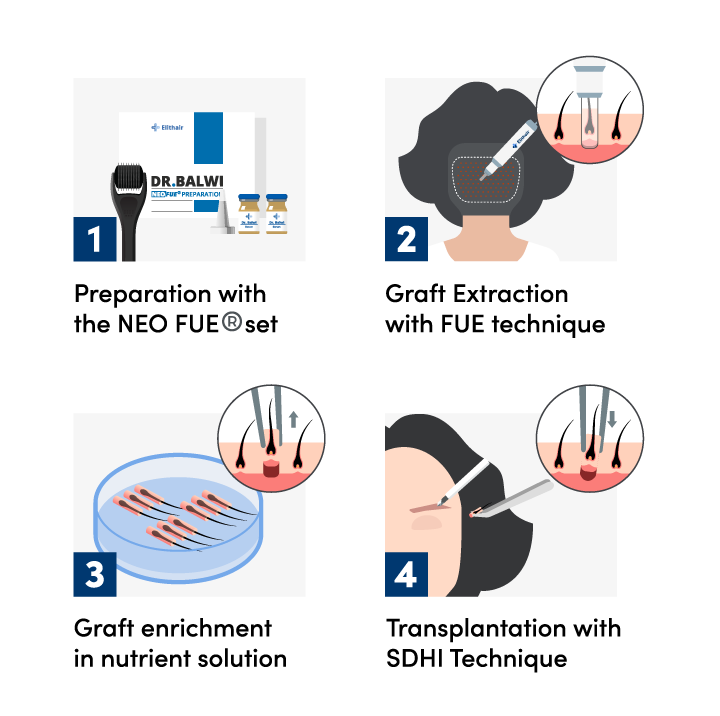 infographic showing the 4 steps of the eyebrow transplant procedure