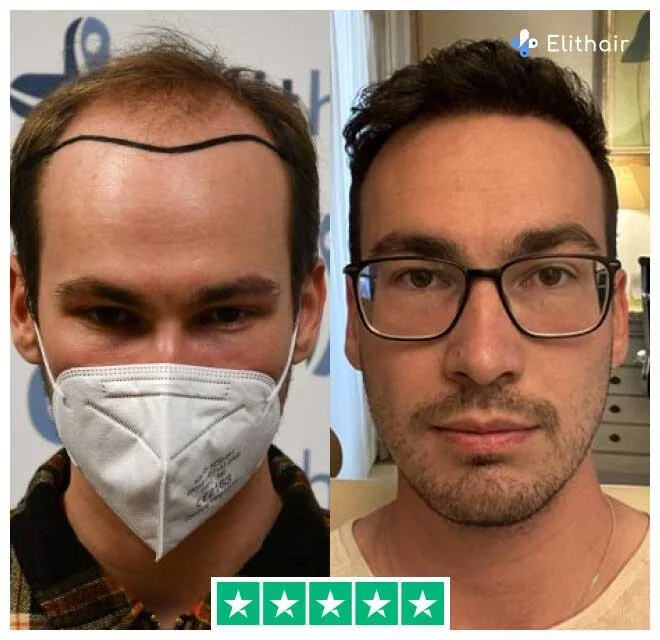 Before and after dhi hair transplant with 4700 grafts from patient marcel