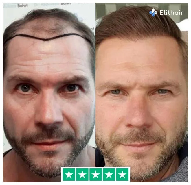 Before and after sapphire hair transplant with 4100 grafts from patient marcus