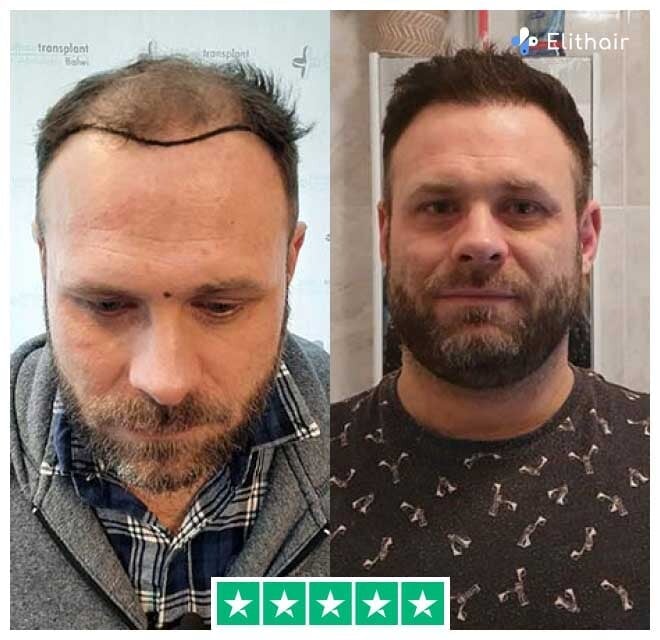 Before and after percutaneous hair transplant with 3700 grafts from patient michael