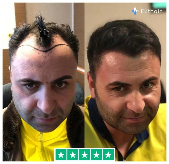 Before and after sapphire hair transplant with 2700 grafts from patient murat