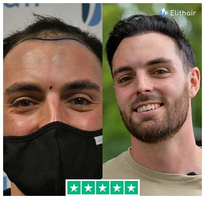 Before and after dhi hair transplant with 3700 grafts from patient sebastian