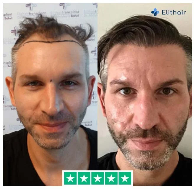 Before and after sapphire hair transplant with 4250 grafts from patient thomas