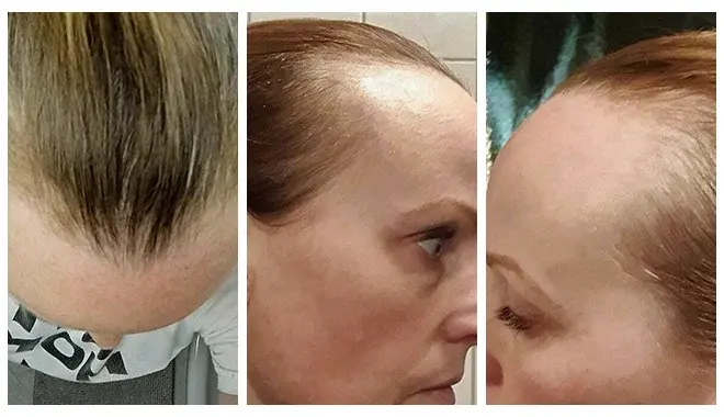 Image showing 3 different views of the scalp of a women having hair loss.