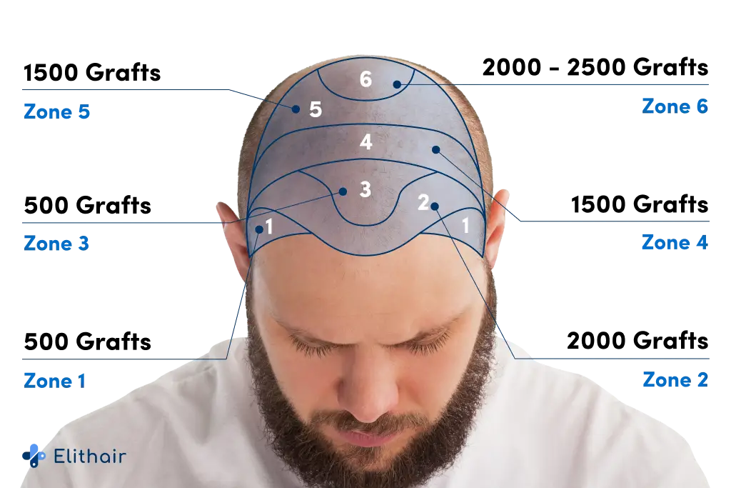 Map of hair loss areas on the scalp, indicating the number of grafts required for a transplant at Elithair.