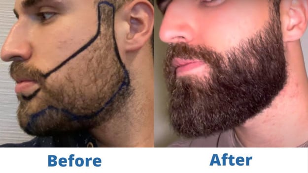 Month-by-month before and after results of a hair transplant at Elithair.