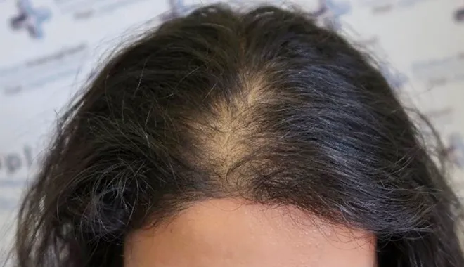 Picture of thinning hair in women due to hair loss