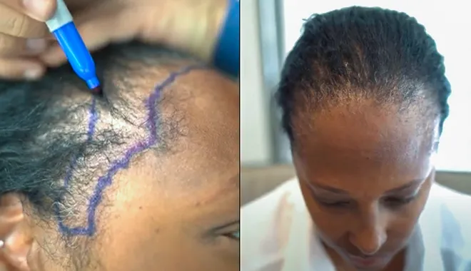 Illustration of traction alopecia hair loss treated at Elithair hair clinic.