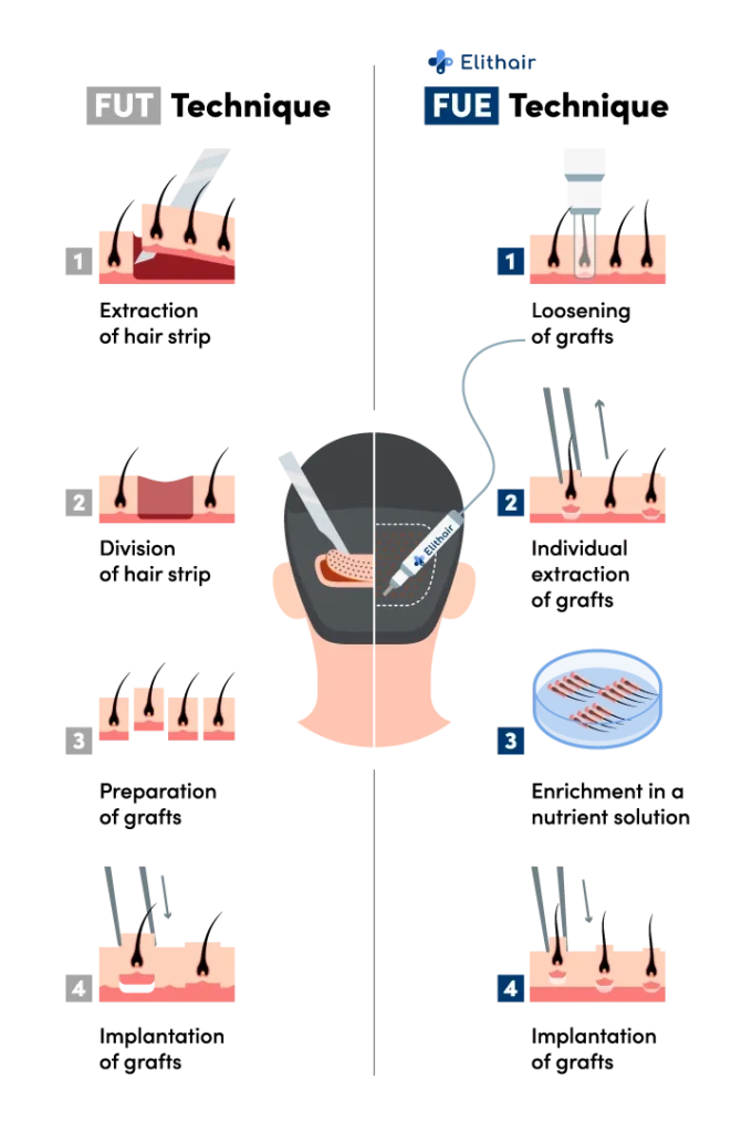 Infographic showing the differences between the FUE and FUT hair transplant techniques