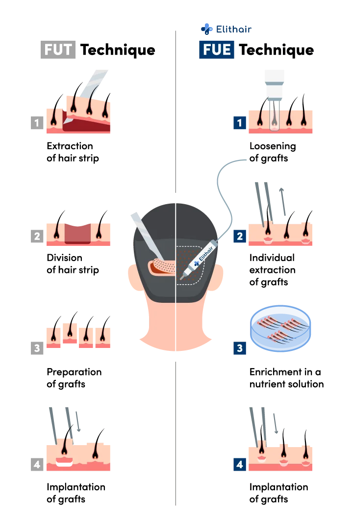 Infographic showing the differences between the FUE and FUT hair transplant techniques