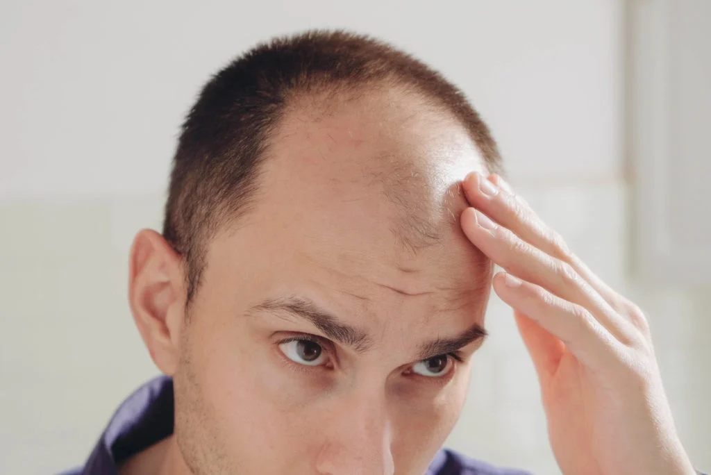 A man furrows his brow and touches his receding hairline with one hand.