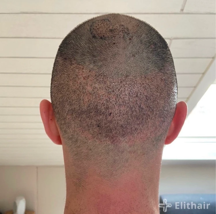 The back of a patient's head following a hair transplant surgery.