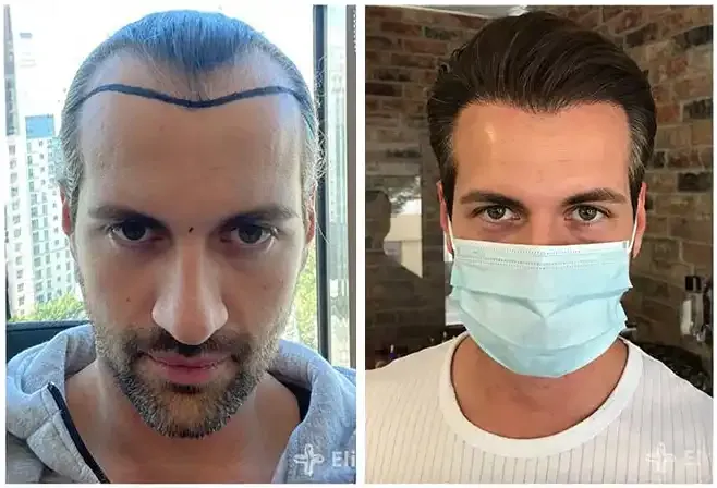 Before and after comparison of an Elithair patient after hair transplantation – clearly visible thicker hairline