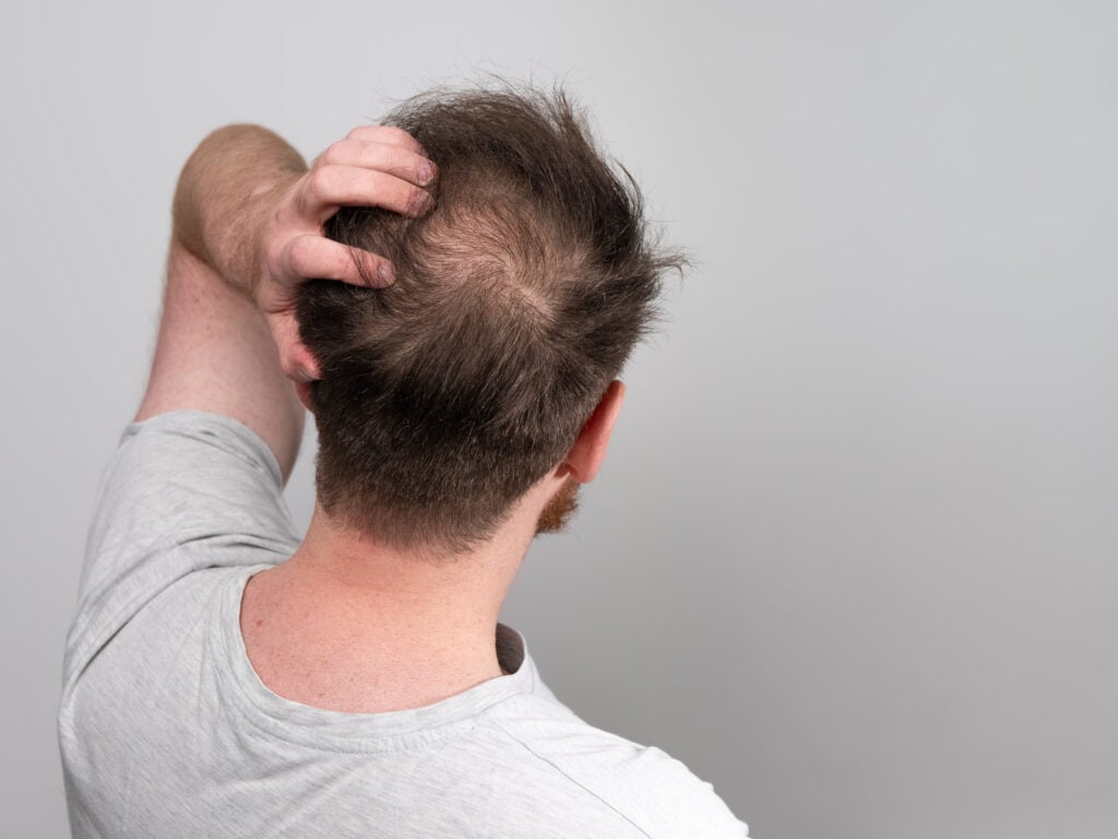 A man suffering from hair loss.