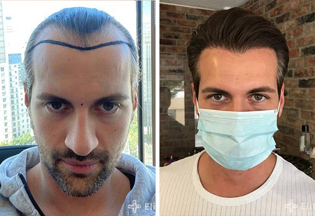 Before and after photos of an Elithair patient, whose hair was revitalised through a hair transplant procedure.