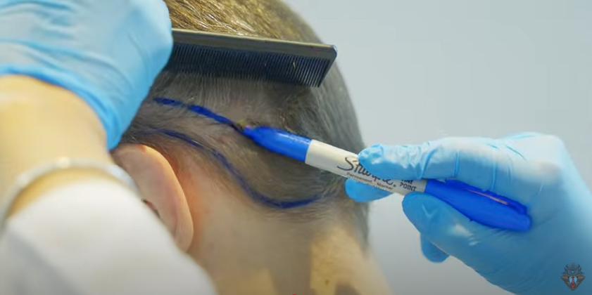 Elithair staff map out the donor area on Skill4ltu's head.