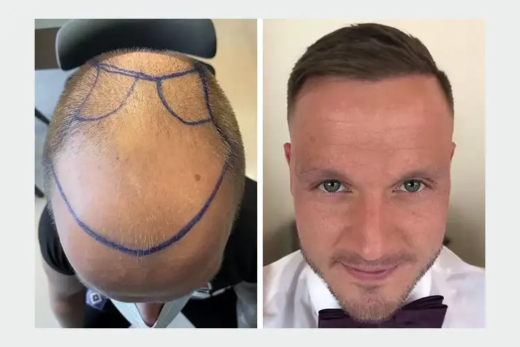 Before and after picture of Elithair patient Dominik K. after a successful hair transplant