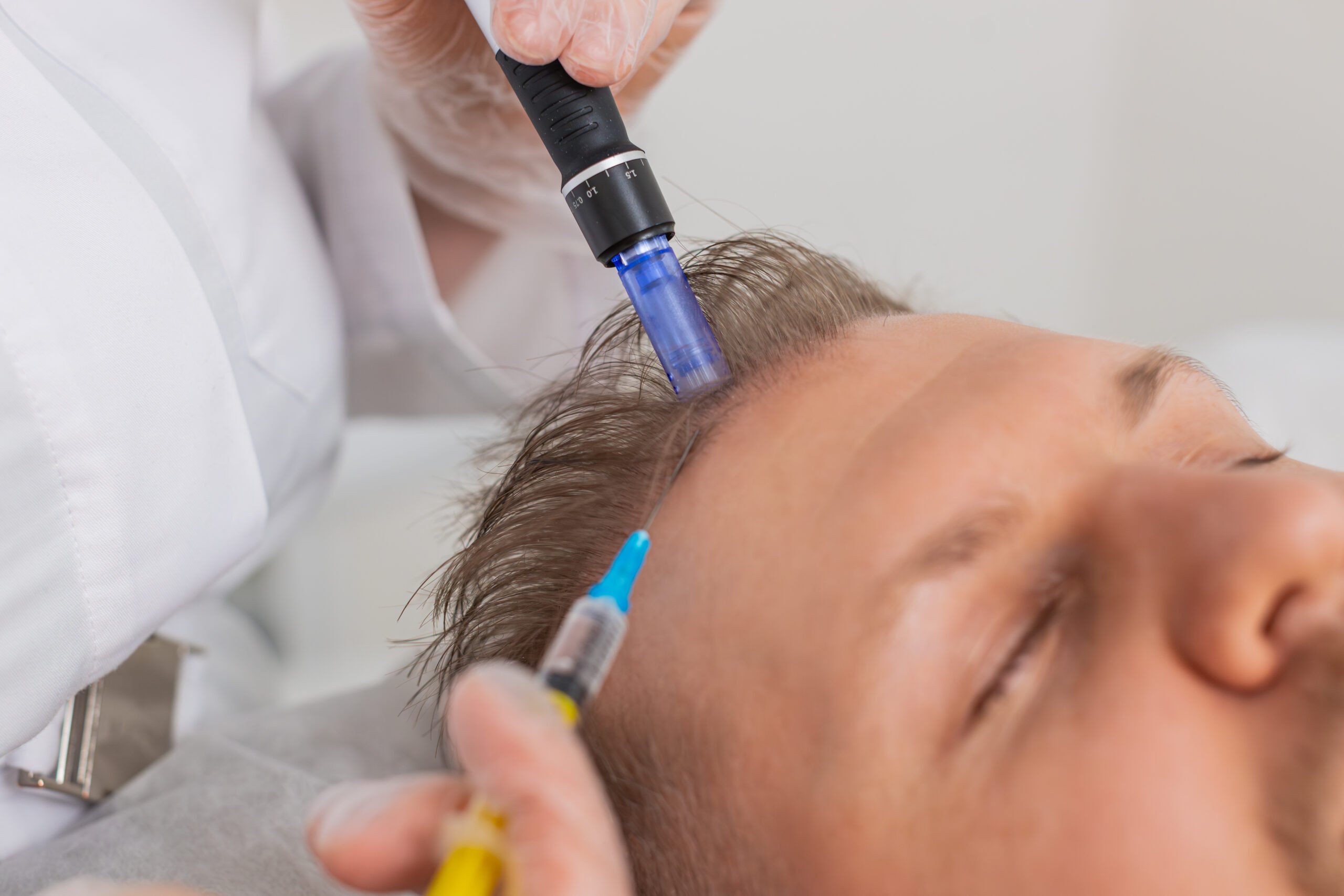 A male patient undergoing exosome therapy to treat his hair loss.