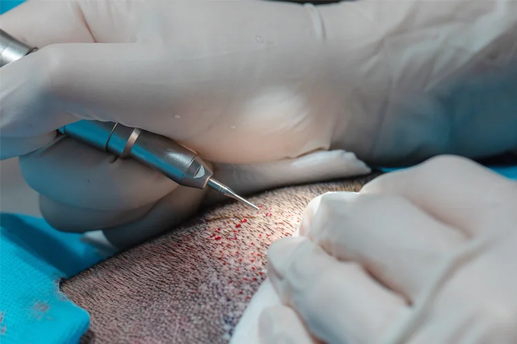 A close-up of an Elithair patient receiving a hair transplant.