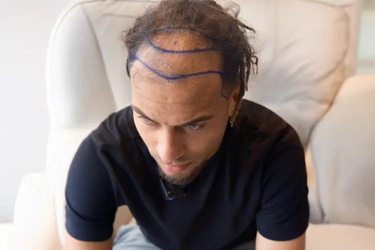 Ouzy See is prepped before his procedure. Blue lines have been drawn on his scalp to show where hair grafts need to be transplanted.