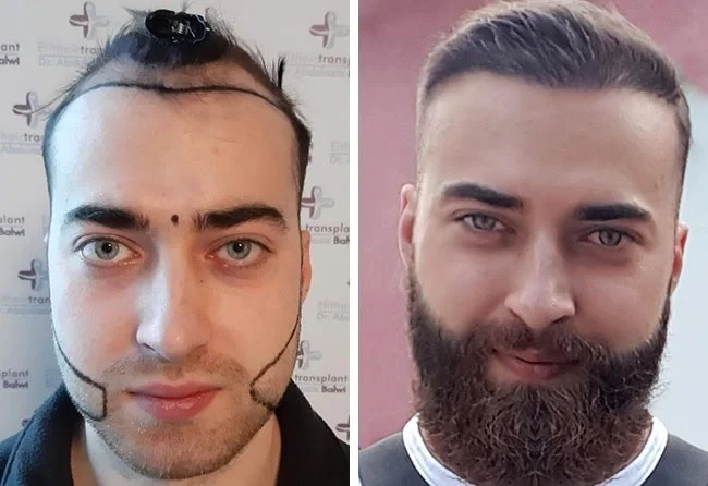 Before and after photos depicting an Elithair patient who received a hair transplant and beard transplant.