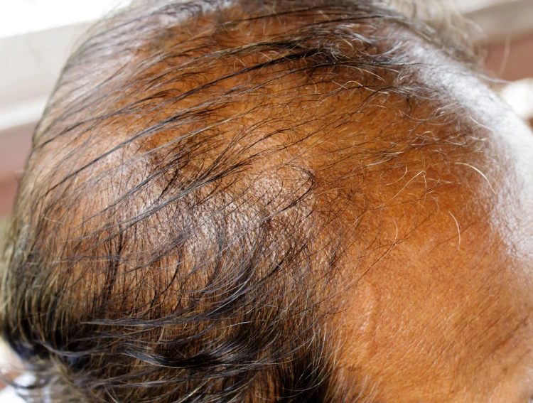 A close-up of a man with thinning hair.