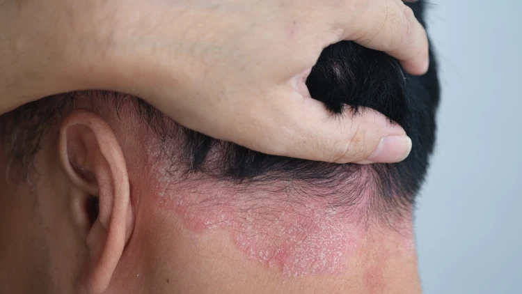 A close-up image of a person with an inflamed scalp near the nape of their neck.