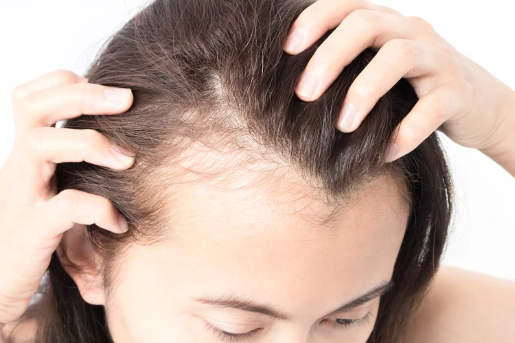 A close-up of a woman with visibly thinning hair.