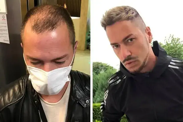 Before and after images of an Elithair hair transplant patient.