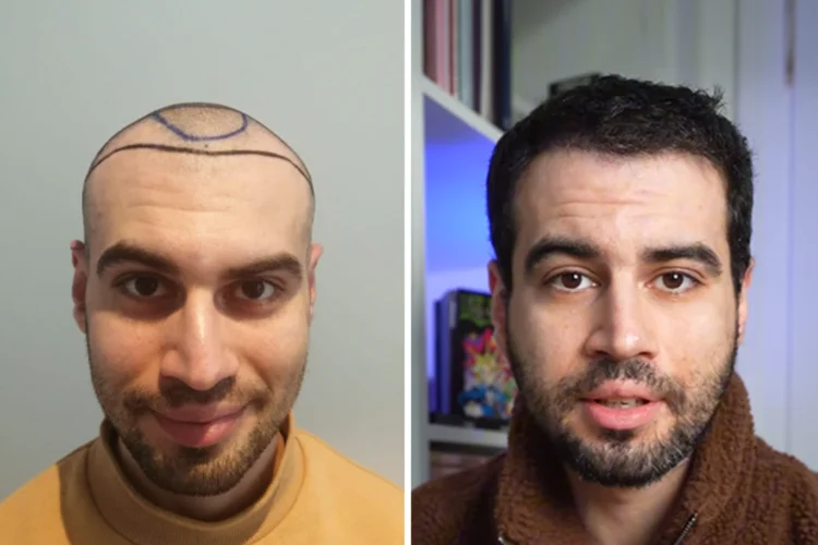 Before and after images of an Elithair hair transplant patient.