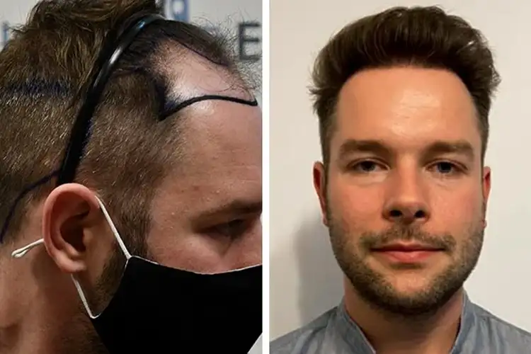 The before and after photos of a hair transplant patient at Elithair.